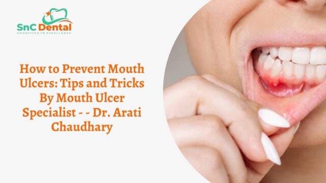 Mouth Ulcer Specialist