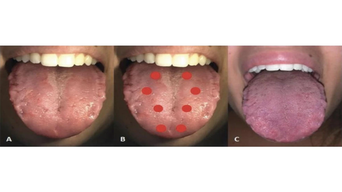 Geographic Tongue