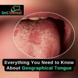 EVERY THING YOU NEED TO KNOW ABOUT GEOGRAPHIC TONGUE