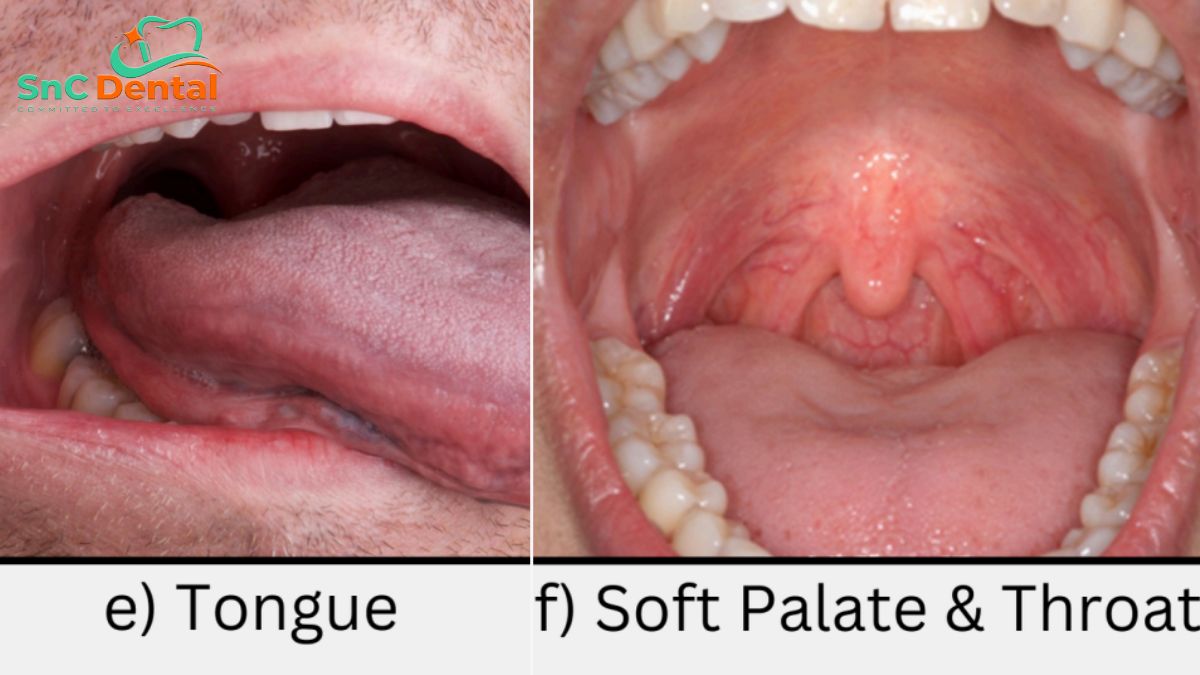 Tongue and soft palates and throat condition - SNC dental Clinic