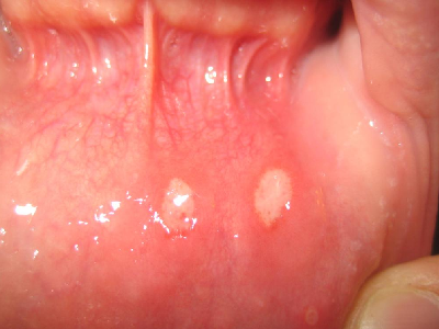 Mouth Ulcer Specialist Doctor Near Me